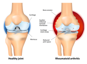 Rheumatoid-Arthritis